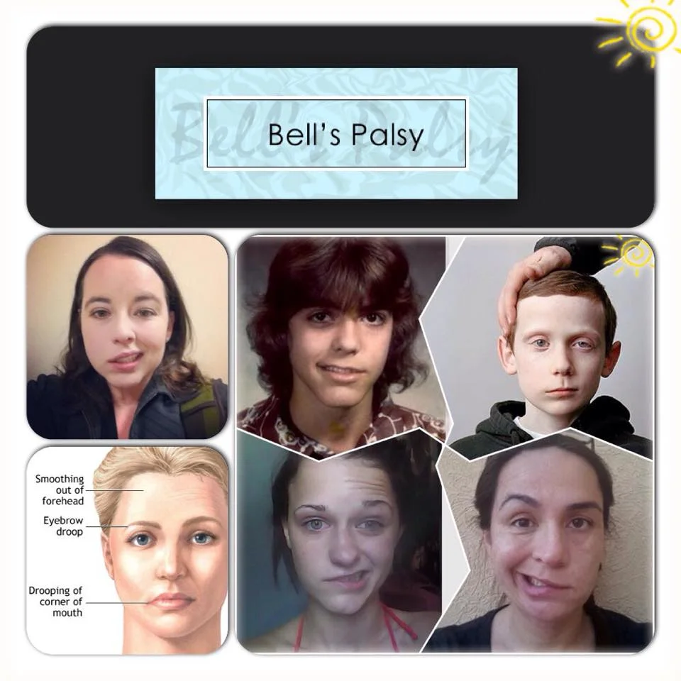Bell’s Palsy