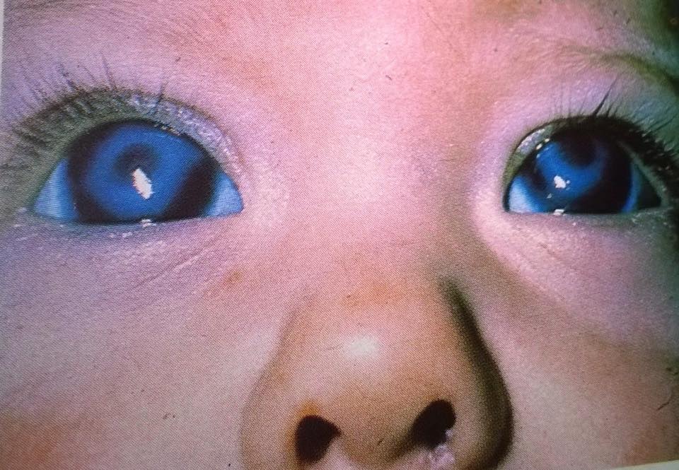 Congenital Cataracts in a baby caused by the Rubella virus, otherwise known as German Measles