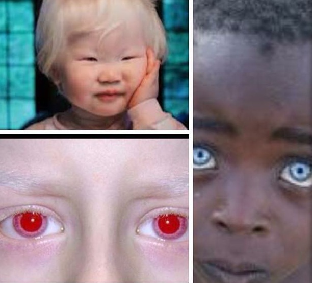 pegs Cater Stoop Ocular Albinism – Diminished Melanin in the eyes, skin and hair. — Kiddies  Eye Care