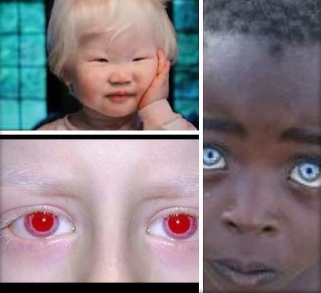 Ocular Albinism – Diminished Melanin in the eyes, skin and hair.