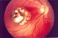 Toxoplasmosis Gondii