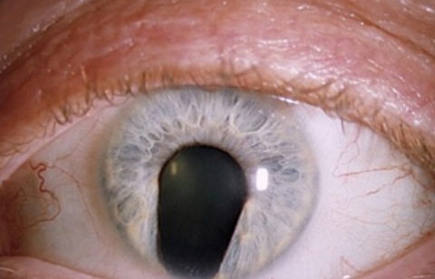 Iris Coloboma