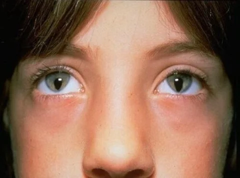 Bilateral-Coloboma-in-a-Child.jpg