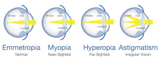 myopia vs hyperopia vs astigmatism viziune nouă astigmatism