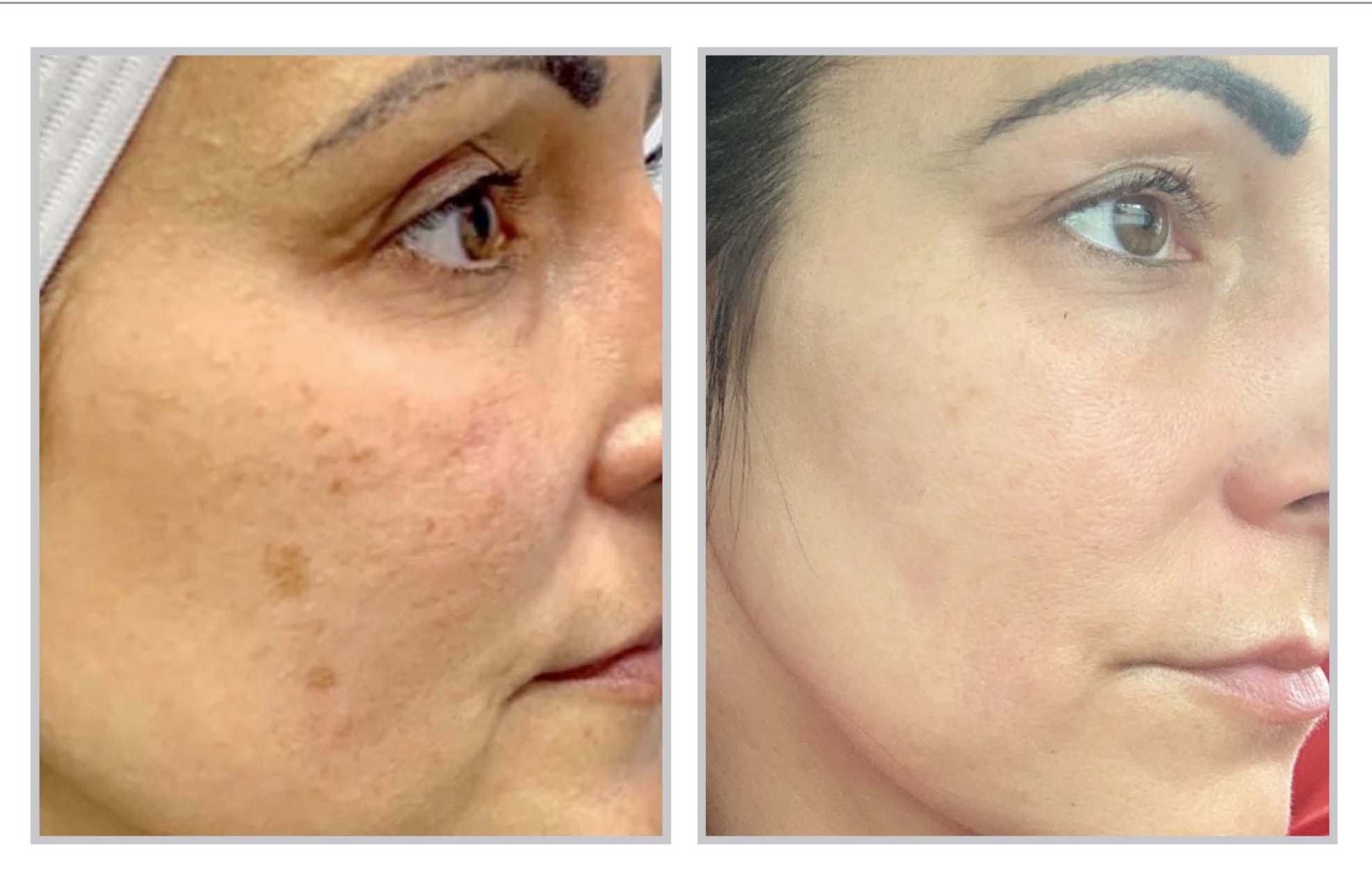 Sciton BBL Hero — Farashe Med & Day Spa