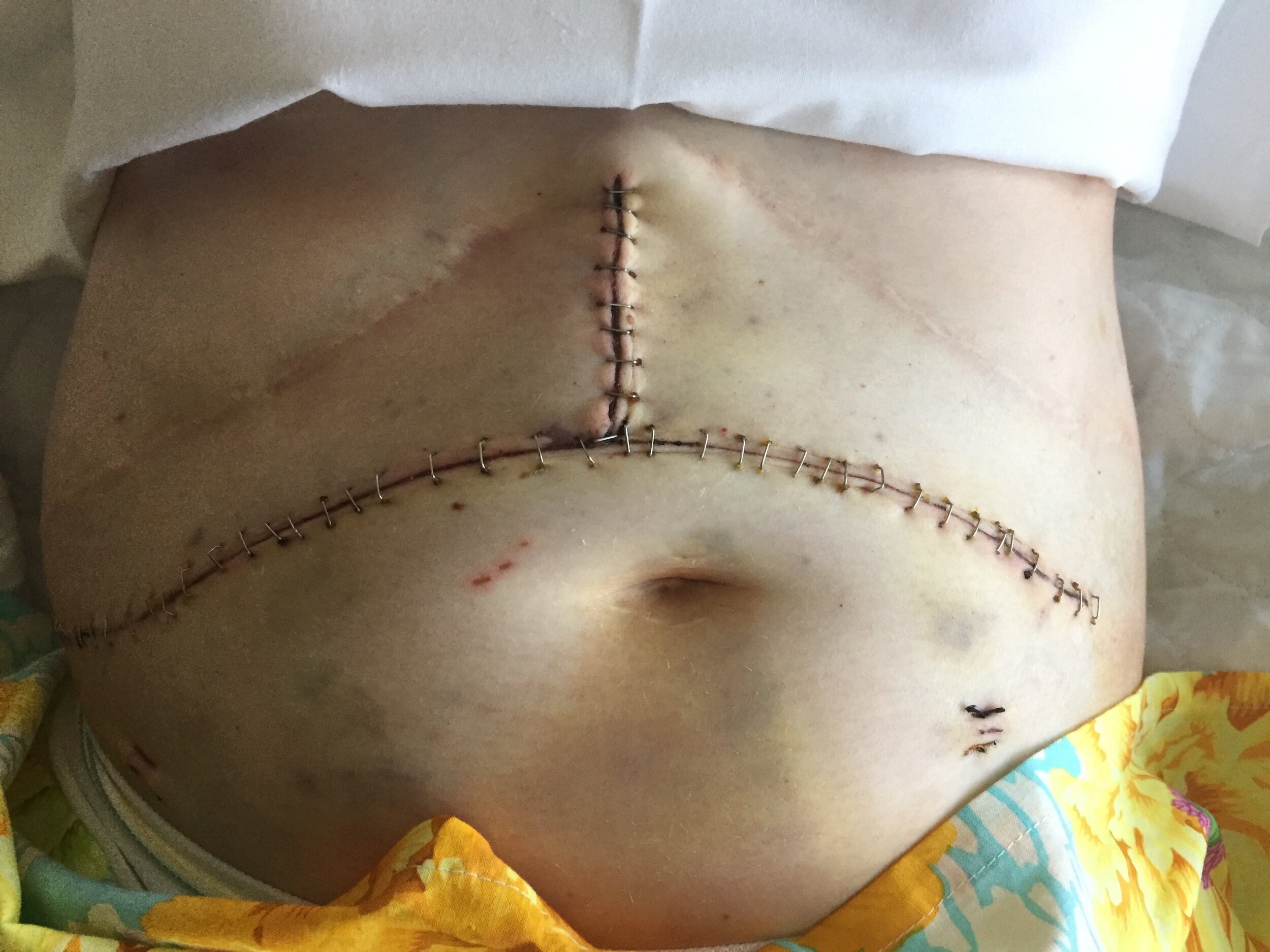 Incision a couple days after liver transplant surgery.JPG