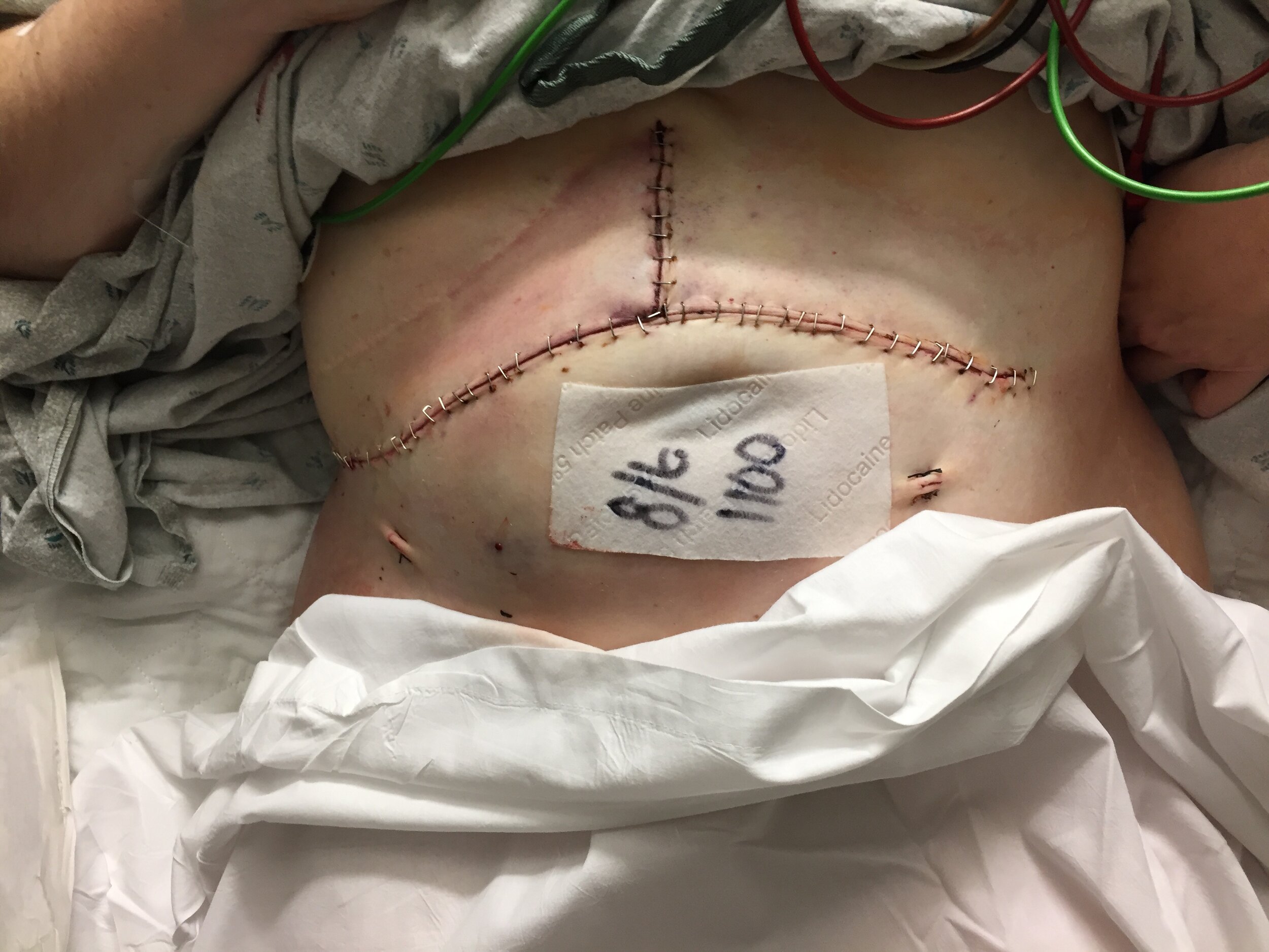 Liver transplant incision when dressing was taken off for the first time.JPG