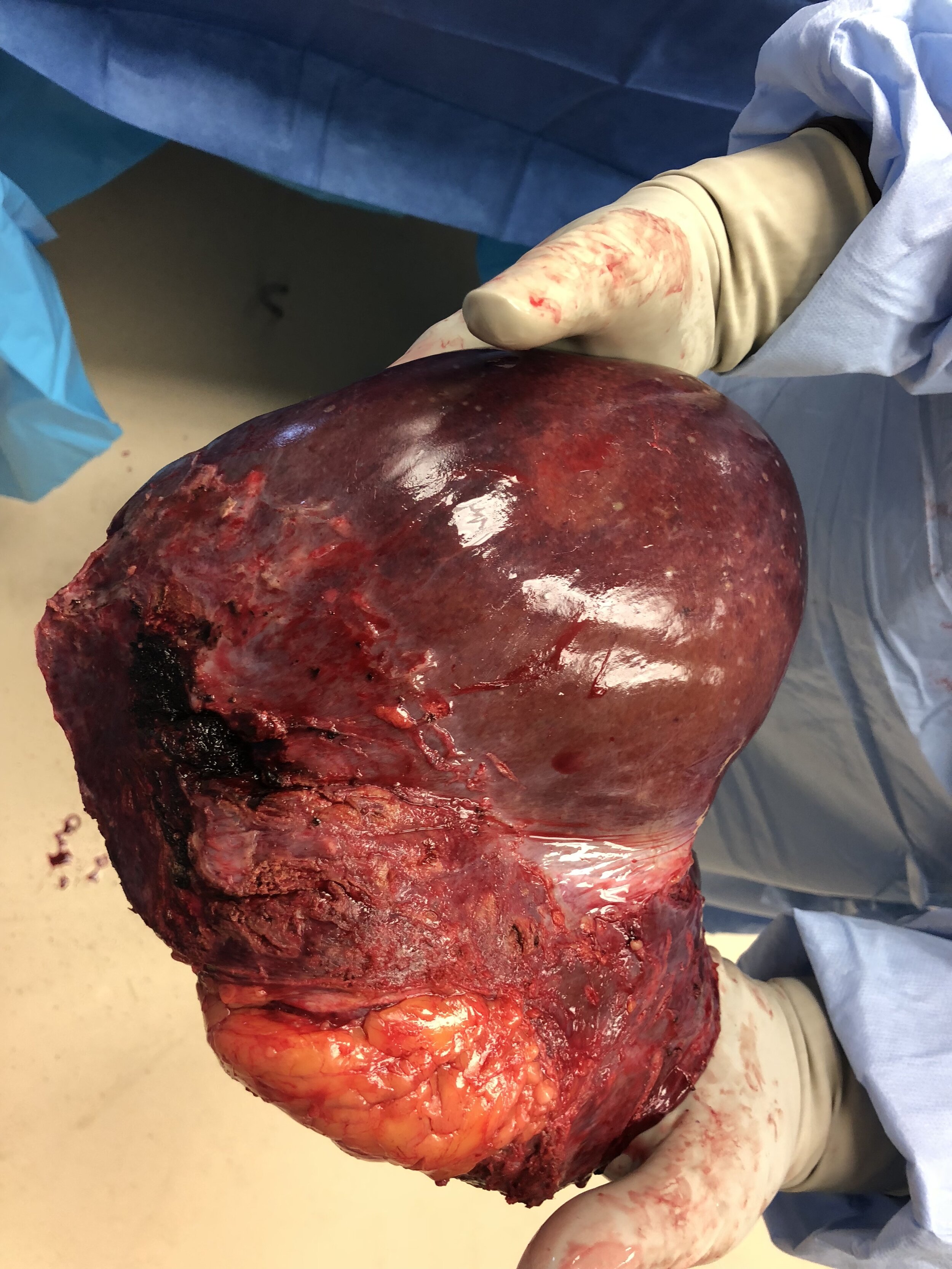 My original liver that they removed.JPG