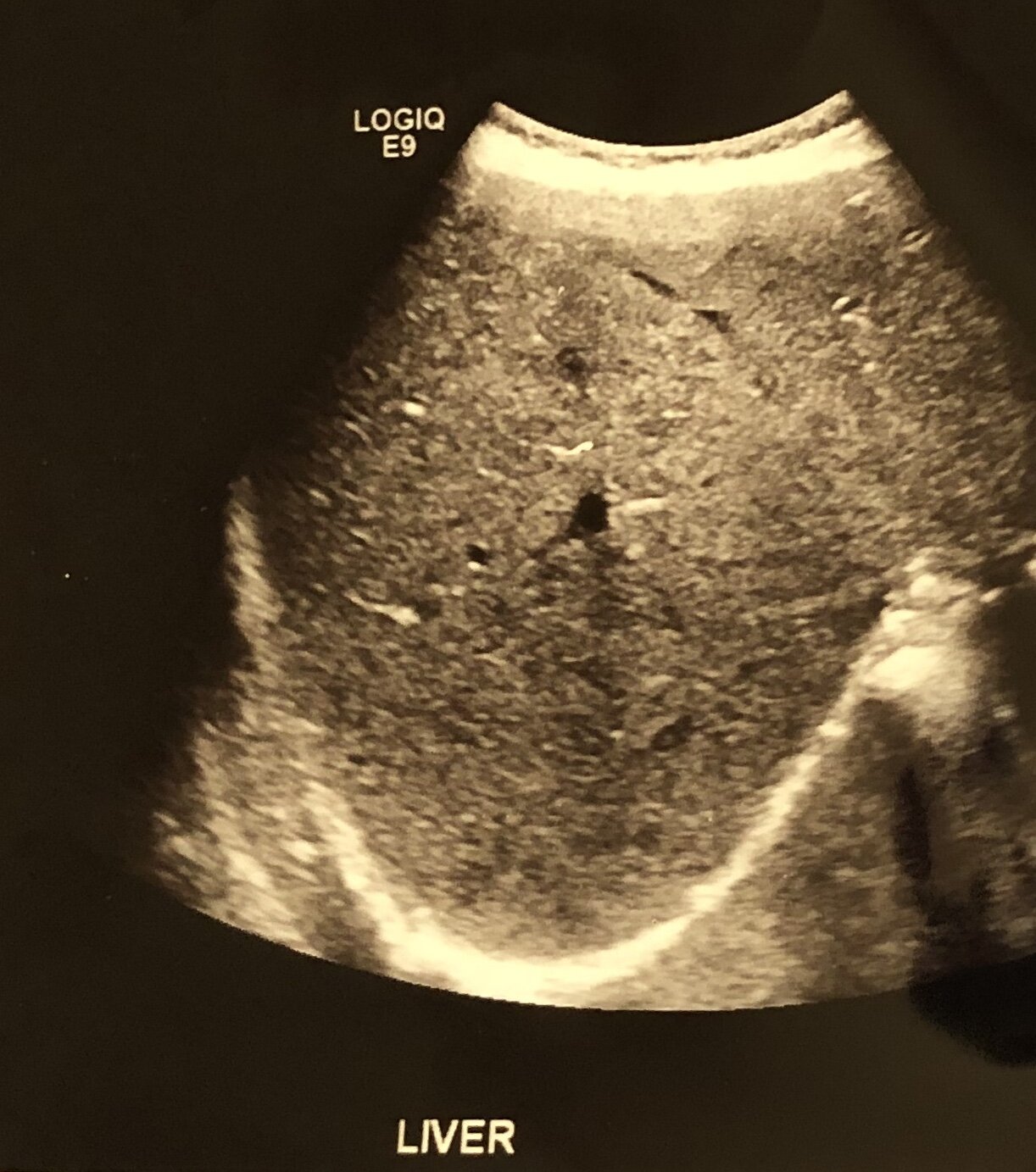 First time I saw my liver on an ultrasound 4.17.19.jpg