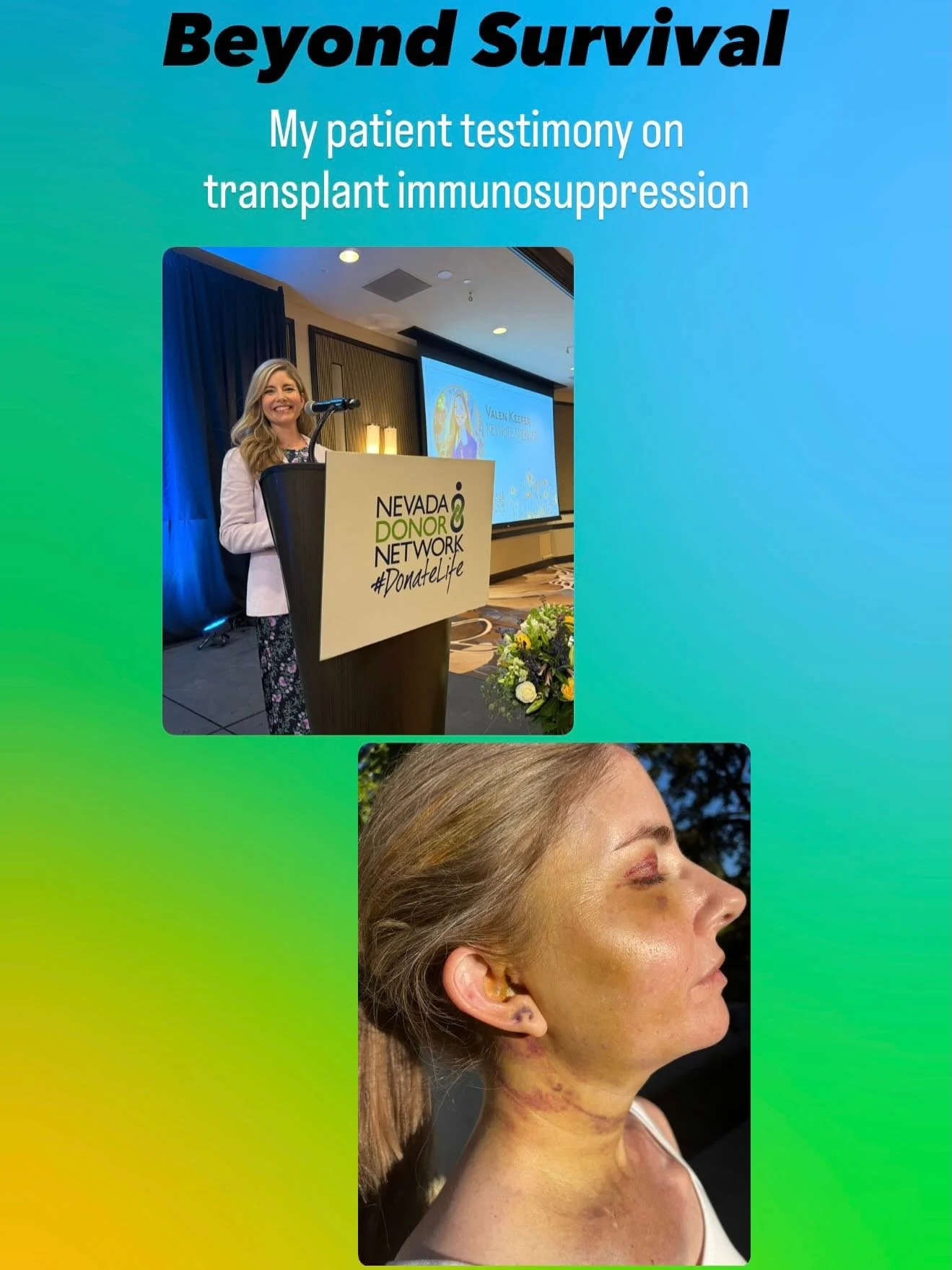 I&rsquo;m honored that the American Society of Transplantation will share my patient testimony on transplant immunosuppression at a Congressional briefing this week. 🙌

I&rsquo;m sharing it here because being honest about our lived experiences can e