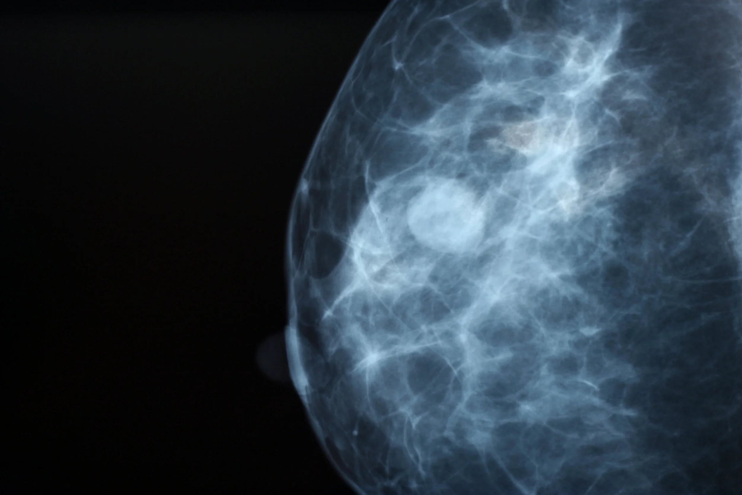 When Do I Start Annual Breast Imaging?