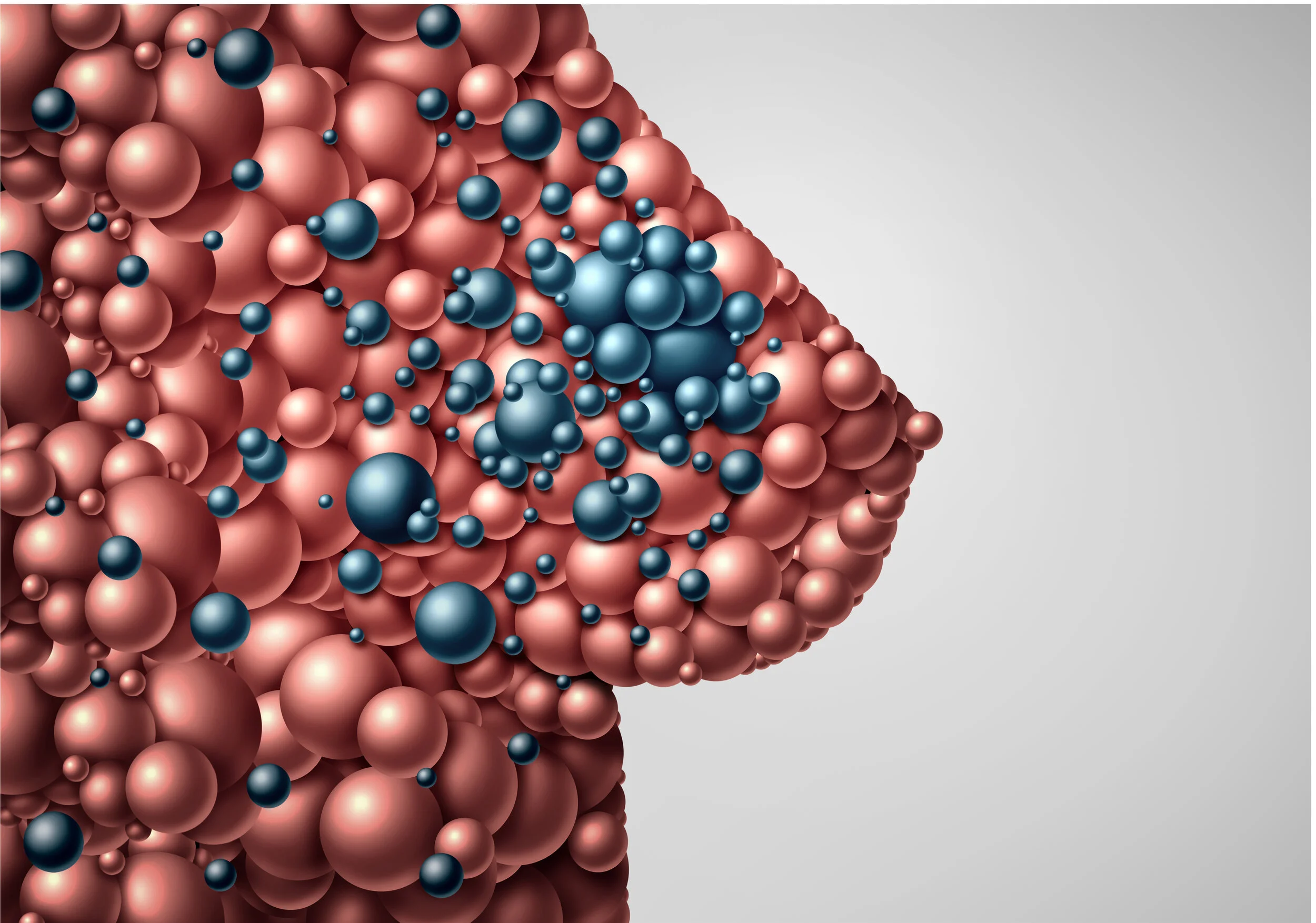 What Are The Different Stages Of Breast Cancer?