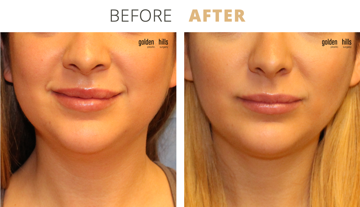 Buccal Fat Pad Removal — Golden Hills Plastic Surgery