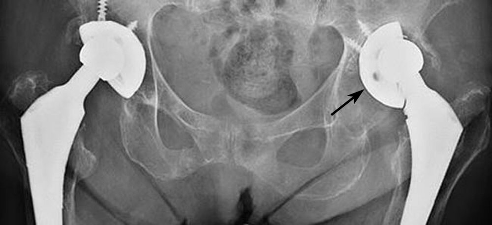 Painful / Worn Hip replacement — Gormack Orthopaedics
