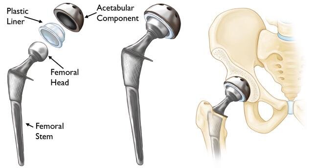 How To Sleep After Hip Replacement (For Faster Recovery)