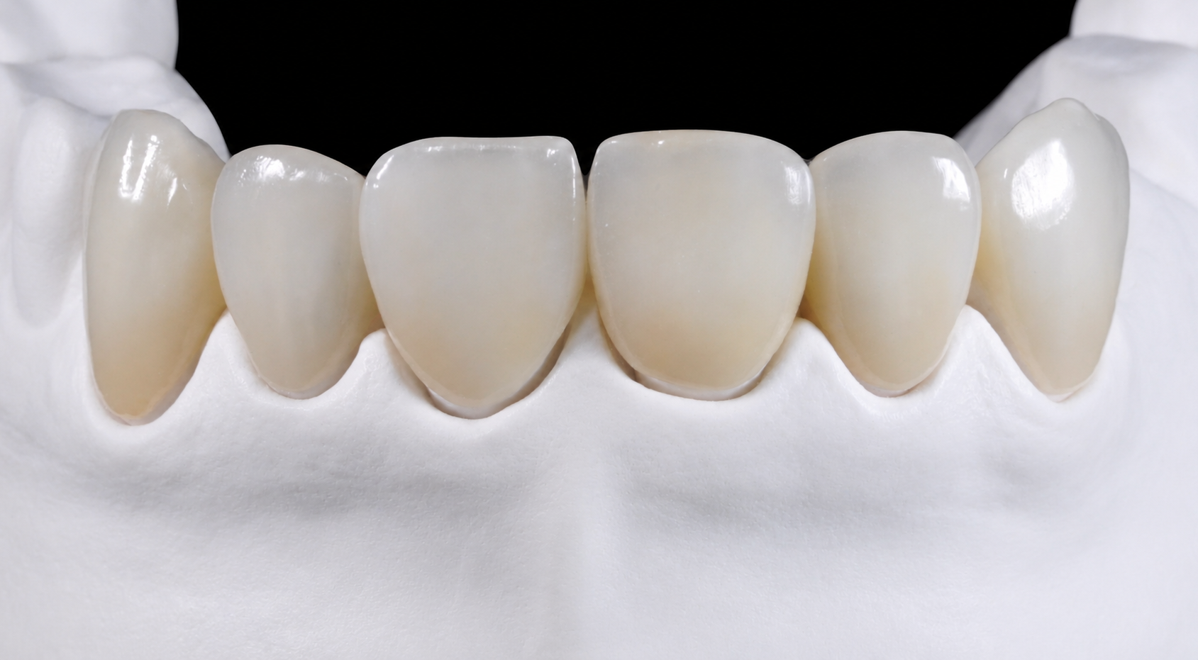 Faccette in ceramica su modello dentale per migliorare armonia ed estetica del sorriso allo Studio Odontoiatrico Mattei a Fondi