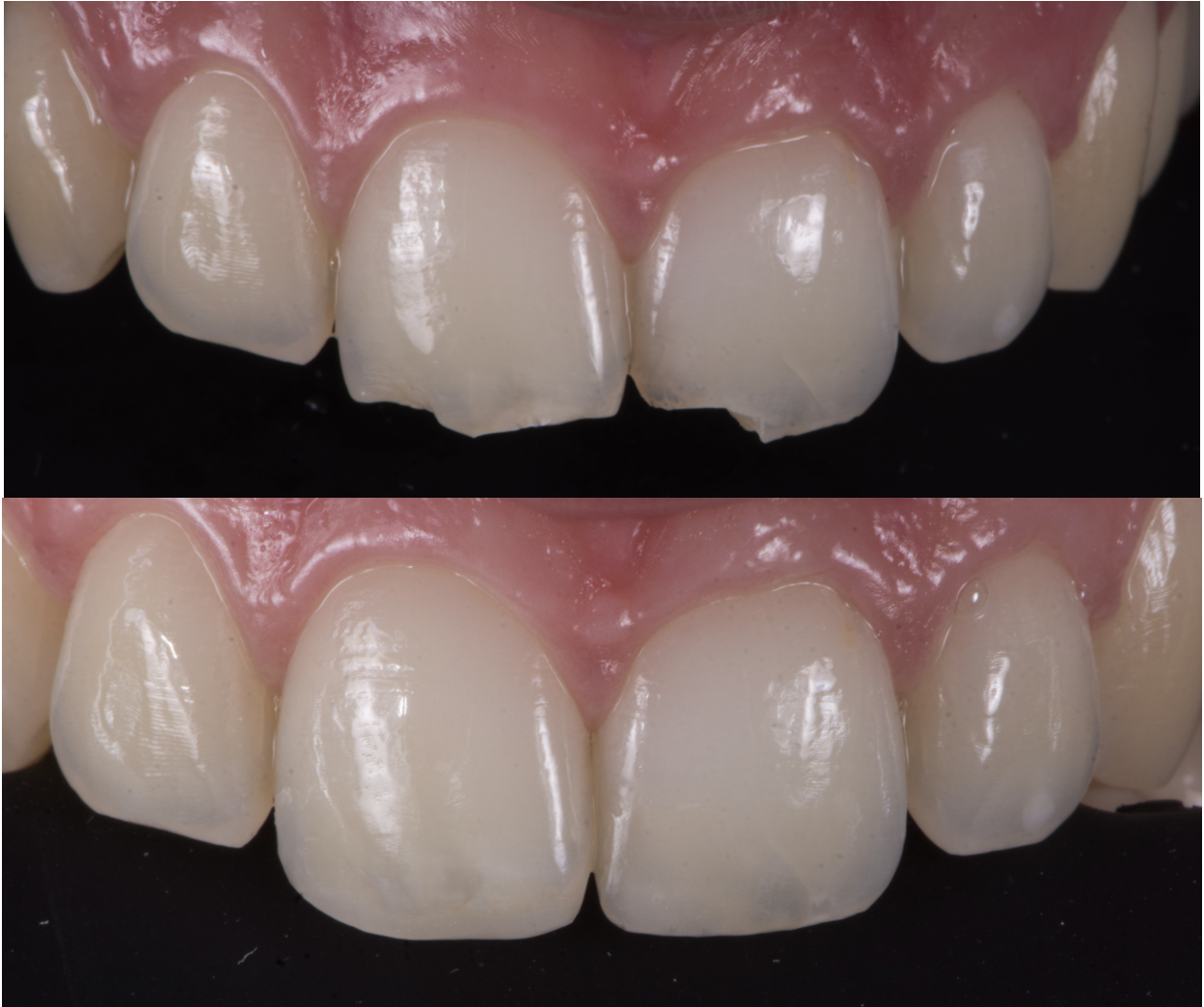 Esempio di odontoiatria restaurativa con ricostruzione invisibile del dente in composito biomimetico.