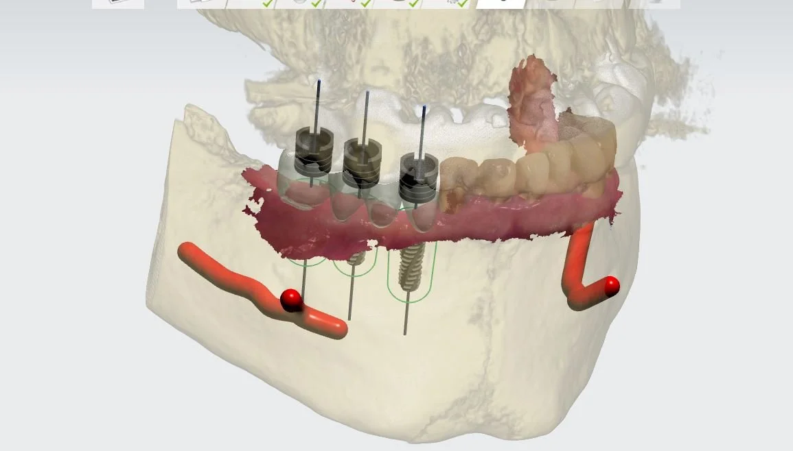 progettazione digitale 3D per inserimento impianti dentali in sicurezza. Si vede il tracciato del nervo mandibolare (in rosso) per evitare rischi chirurgici durante l'intervento.