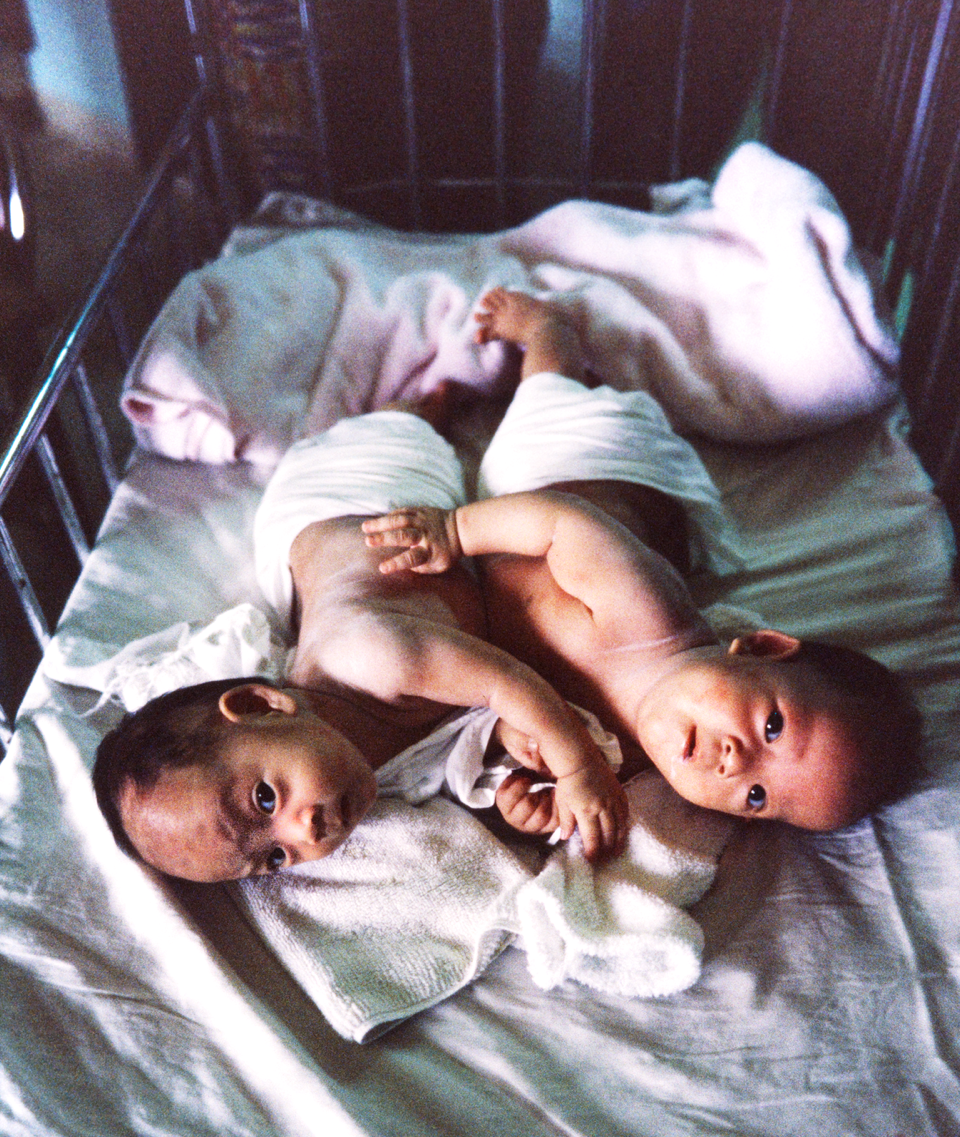 Conjoined twin girls, born in Vietnam 29 years ago from Blair/Goodwin