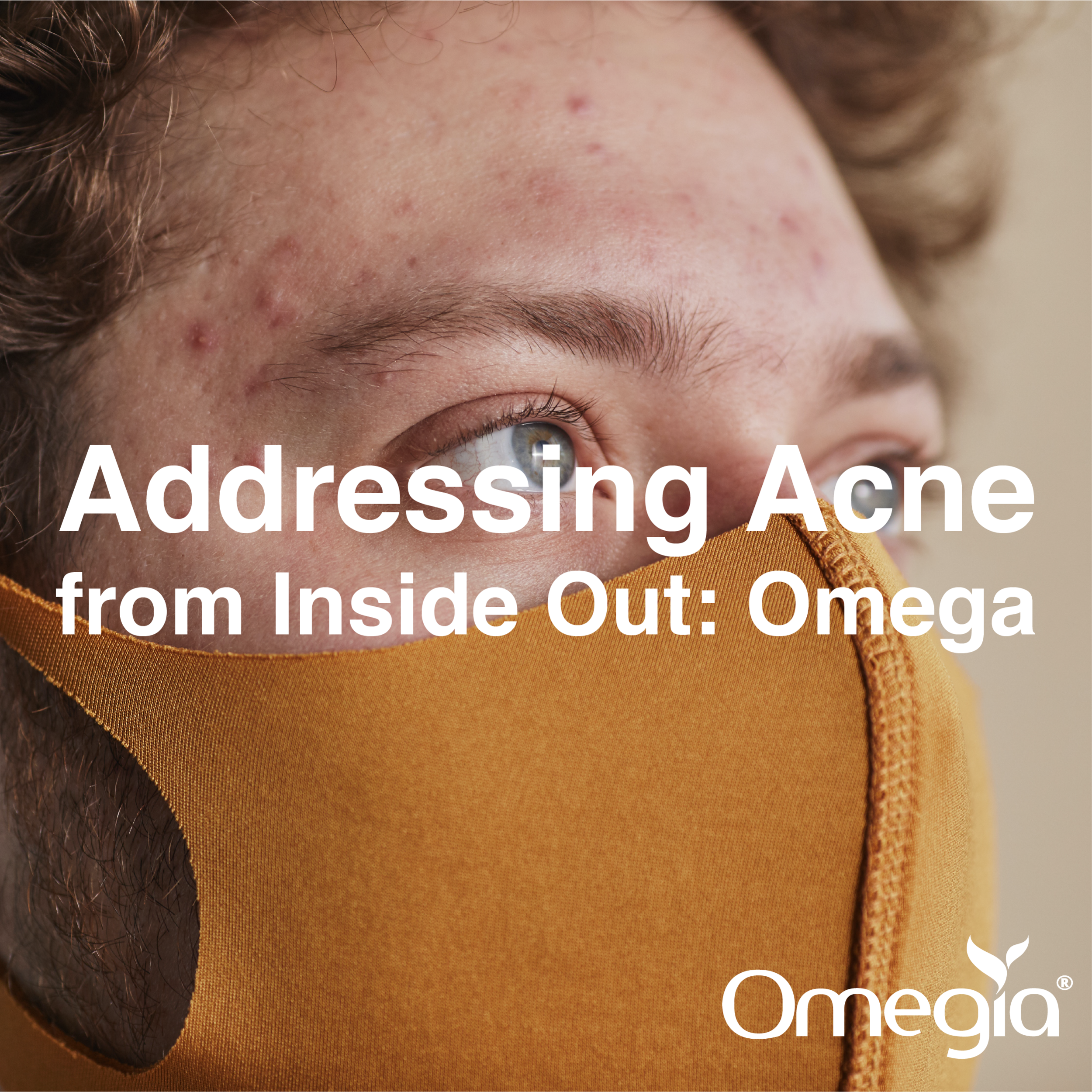 Addressing Acne from Inside Out: Omega 