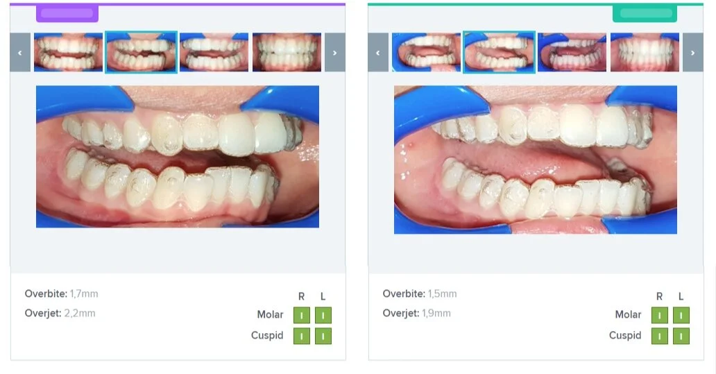 Dental Monitoring — Invisalign Studio
