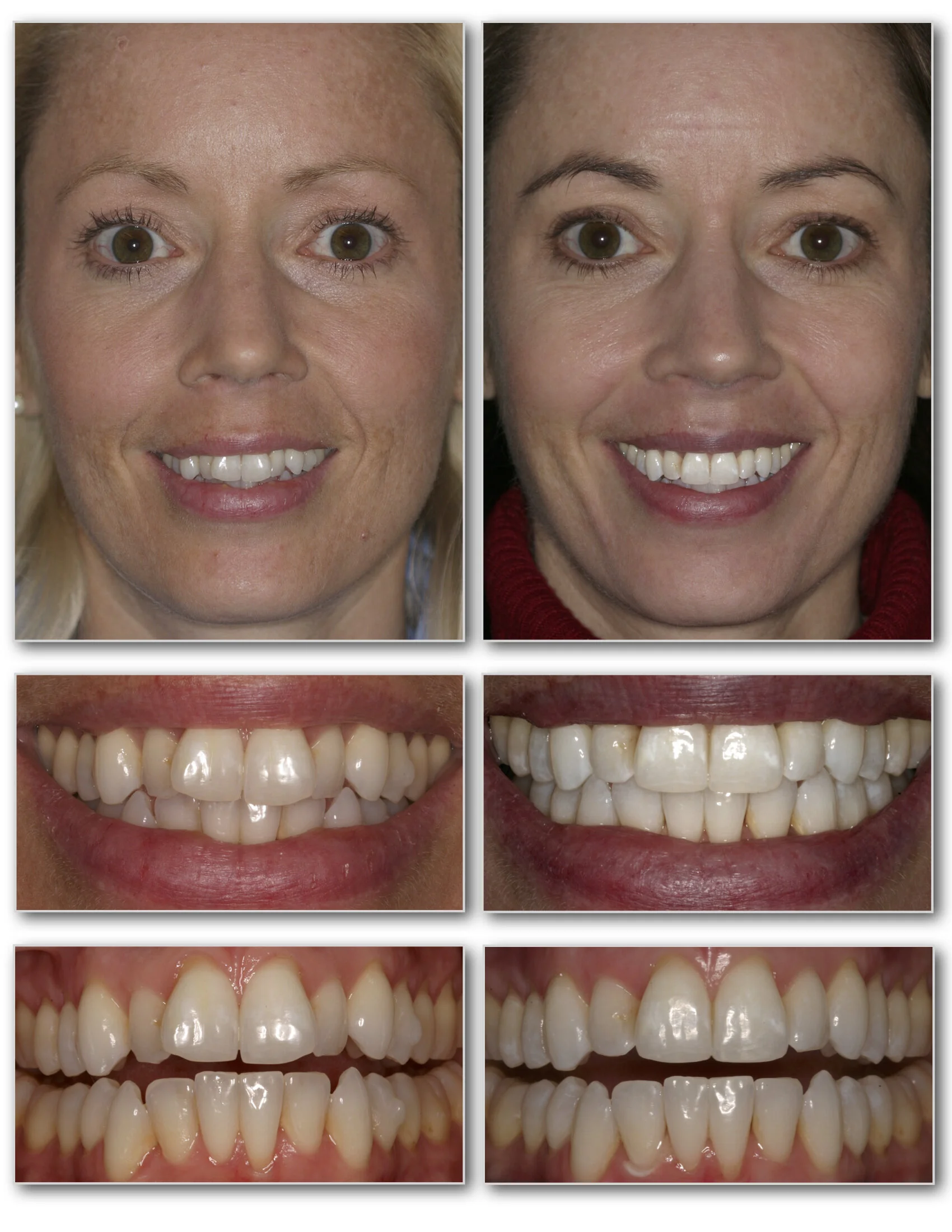 Which Teeth Move First With Invisalign? The 3 Stages Of Treatment – LPWUH
