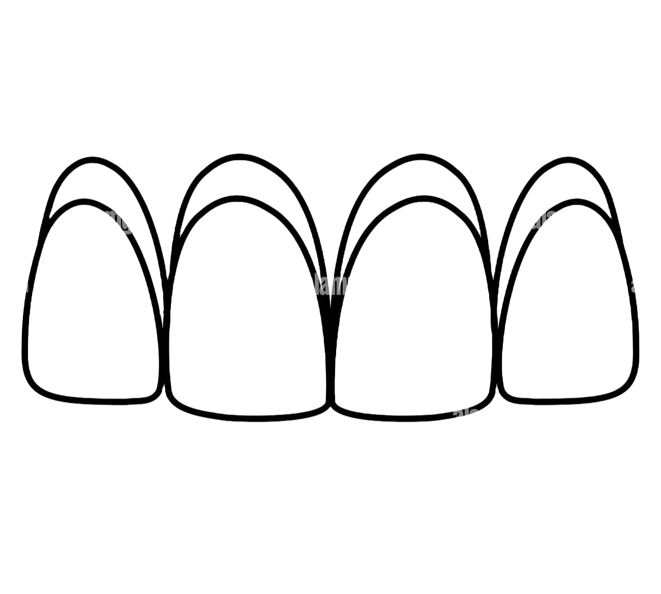 Invisalign aligns teeth for no-prep veneers.