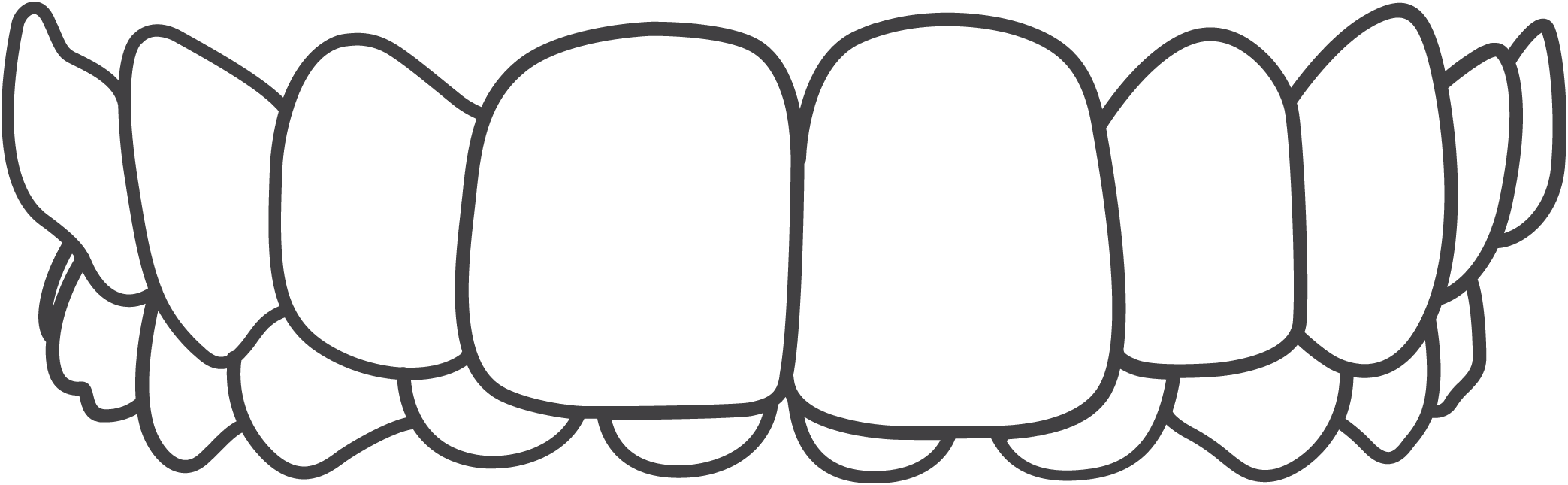 Invisalign treats deep bites/overbites.