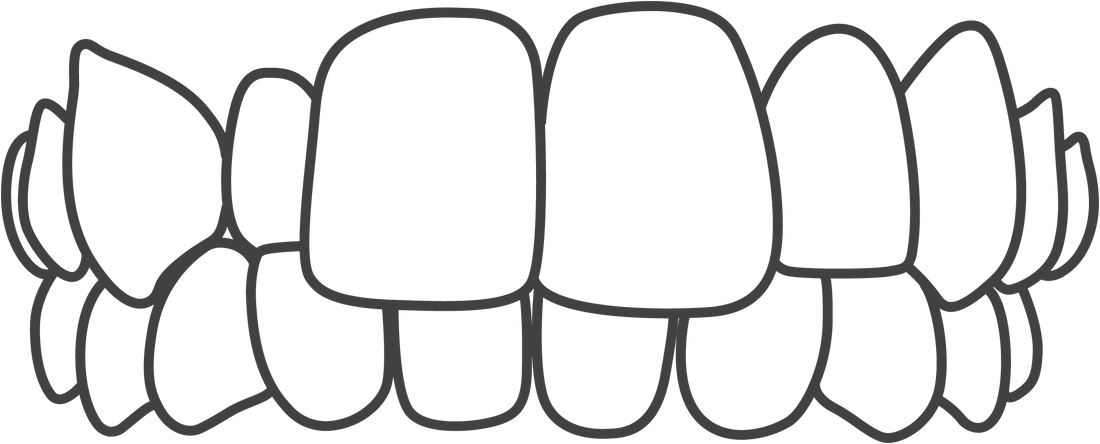 Invisalign treats crossbites.