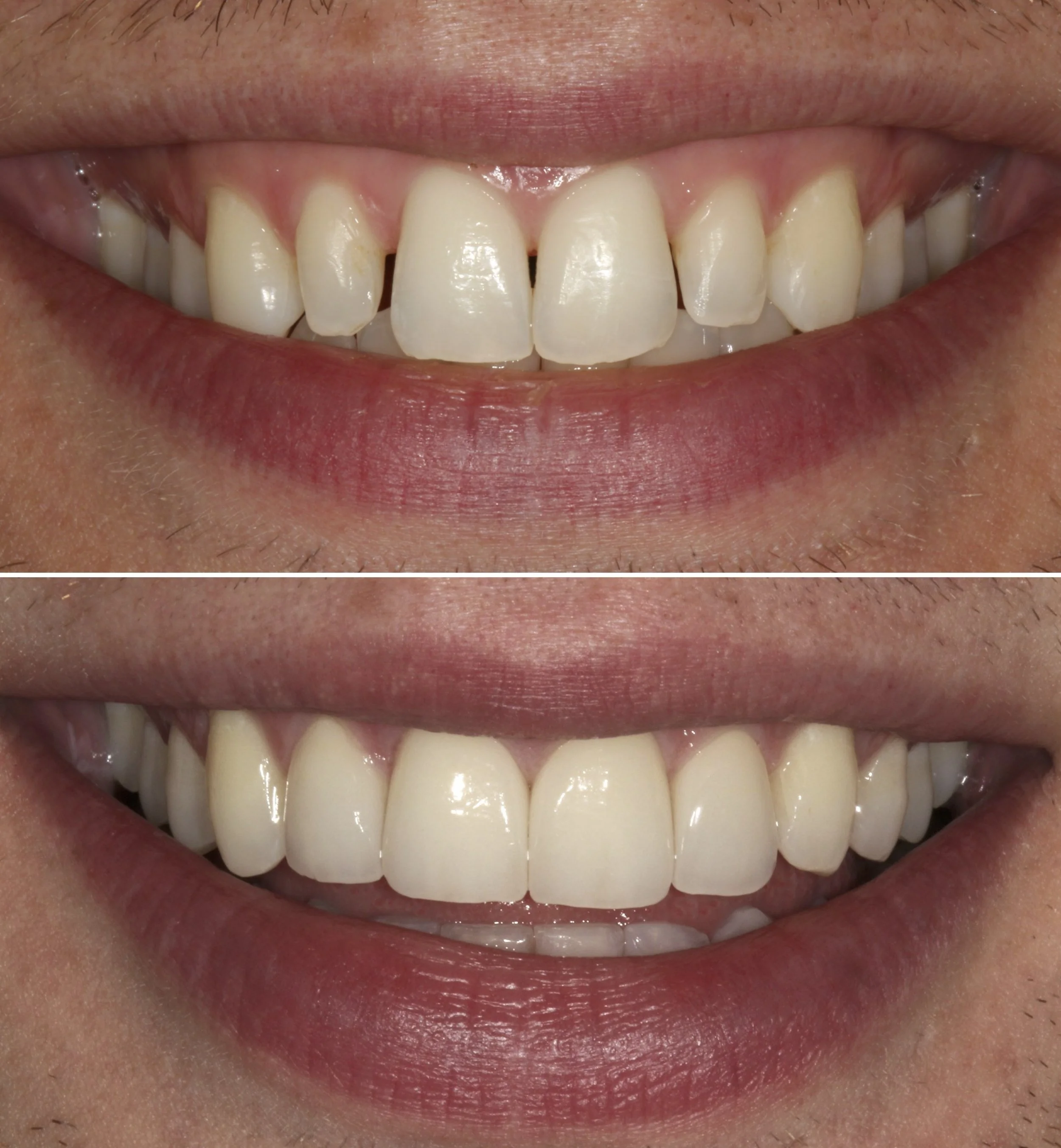 Invisalign before and after - pre no-prep veneers