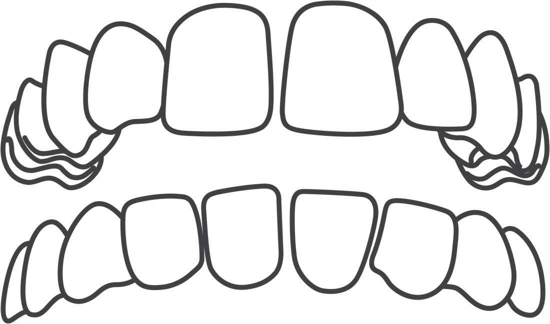 Invisalign treats spacing.