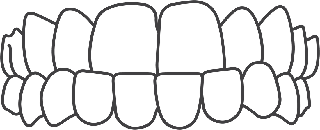 Invisalign treats underbites.