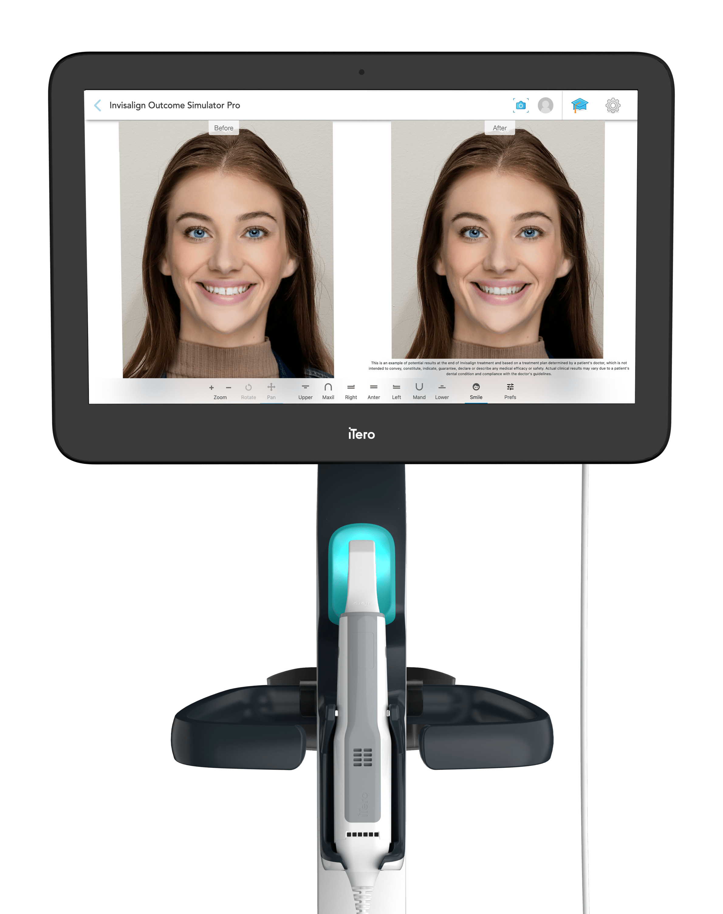 Invisalign Outcome Simulator