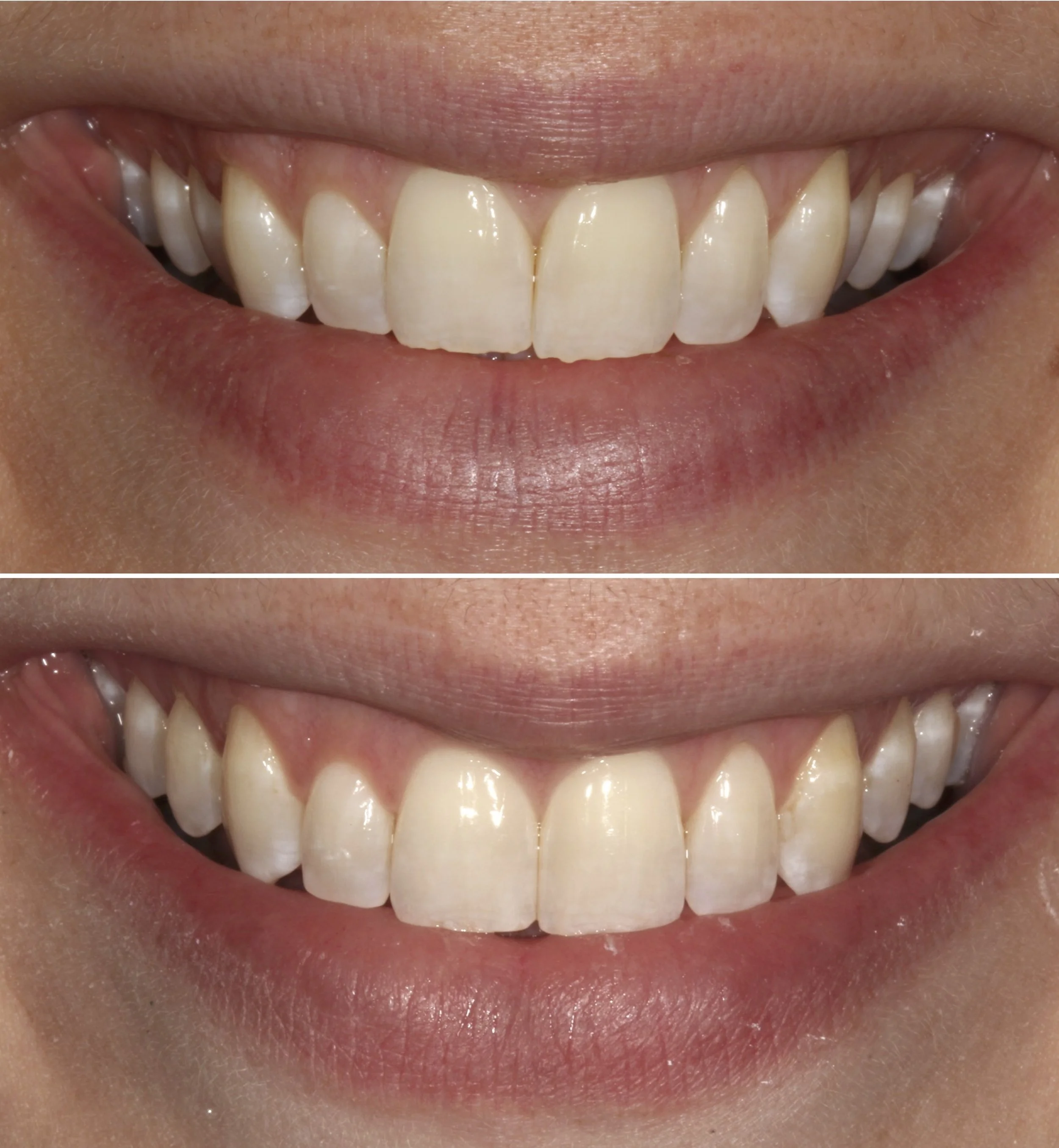 Invisalign before and after - narrow arch