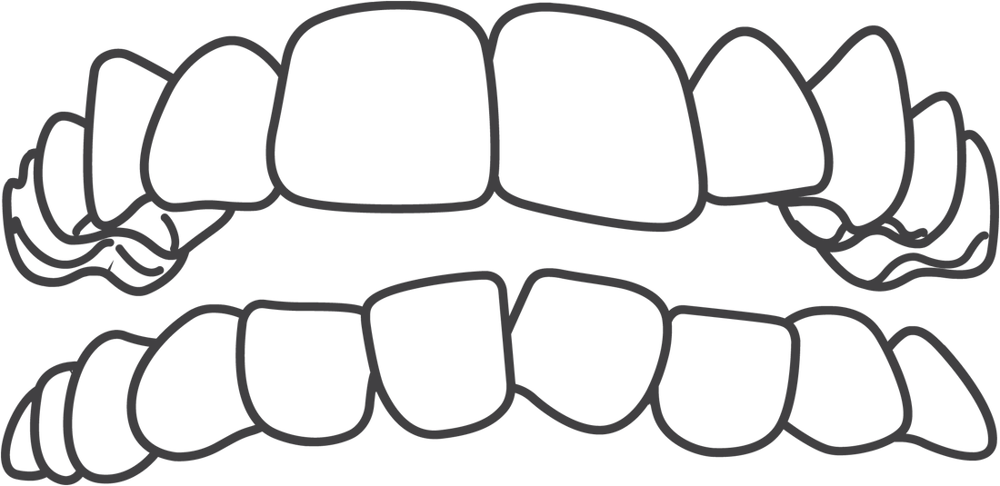 Invisalign treats crowding.