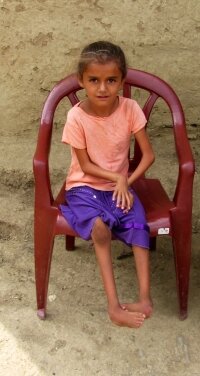 Child with arthrogryposis whom ACTS is helping obtain corrective surgery.