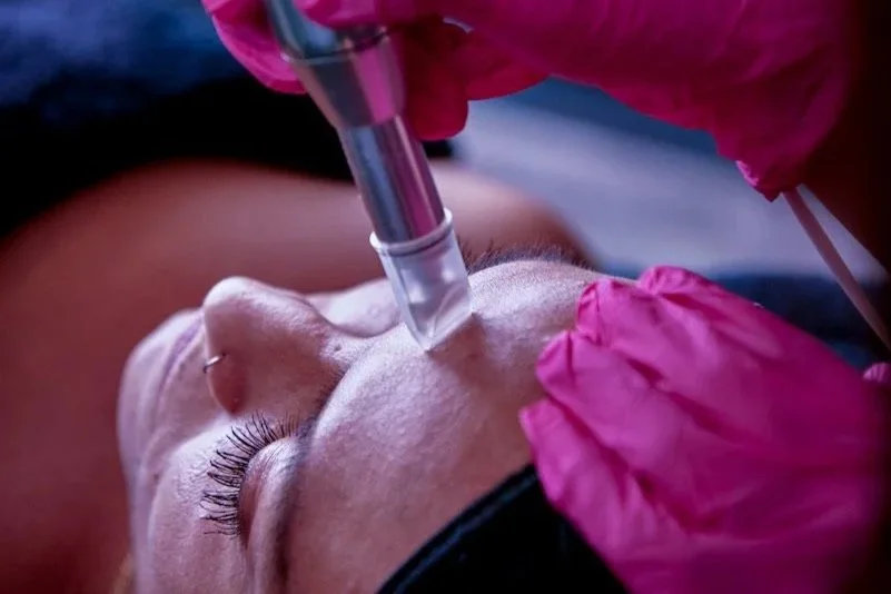 Why Fall Is a Great Time for Microneedling