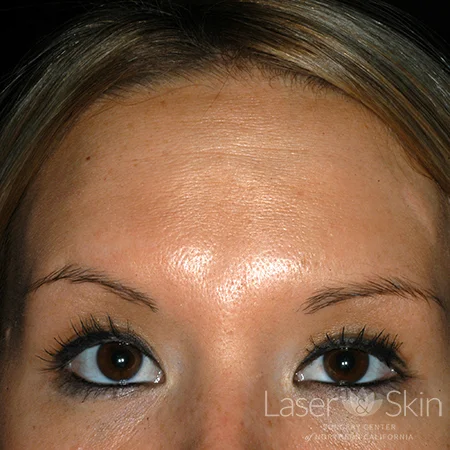Post Botox treatment for forehead lines