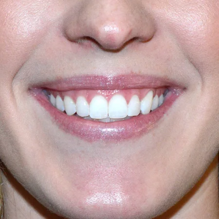 Pre Botox treatment to improve the appearance of a “gummy” smile