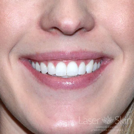 9 days post Botox treatment to improve the appearance of a “gummy” smile