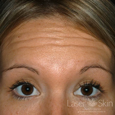 Pre Botox treatment for forehead lines