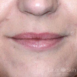Pre Juvederm treatment