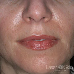 Post Juvederm Hyaluronic Acid Filler to nasolabial folds