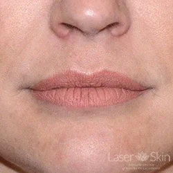 Pre Juvederm treatment
