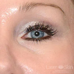 Post Juvederm Volbella Hyaluronic Acid Filler to under eye area
