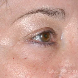 Post Restylane to Under Eye Area