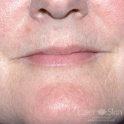 Pre Restylane