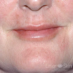 Post Restylane to lips