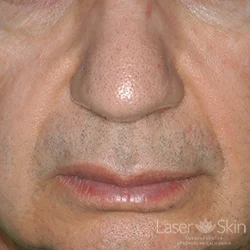 Pre Radiesse Naso Labial Folds