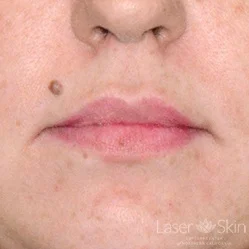 Pre Juvederm Volbella treatment